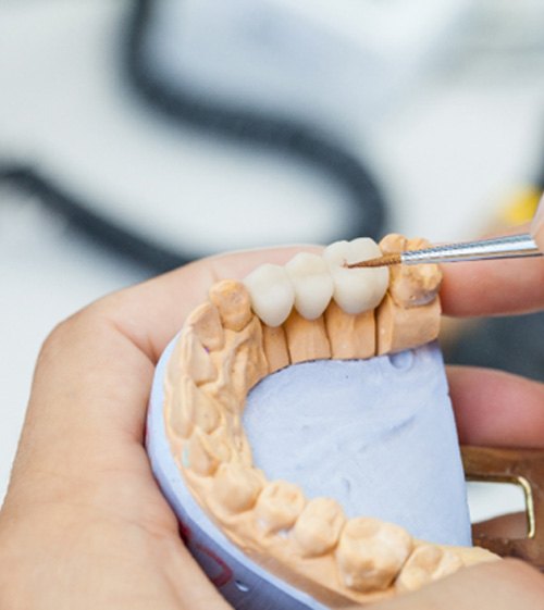 dentist sculpting dental bridge 