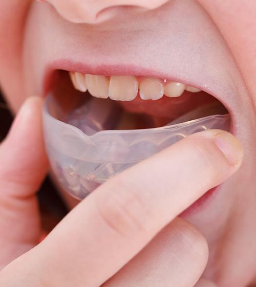 Teen placing athletic mouthguard