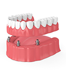 model of an implant denture on the lower arch 
