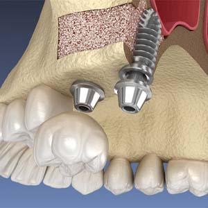 Illustration of dental implant placed at location of sinus lift