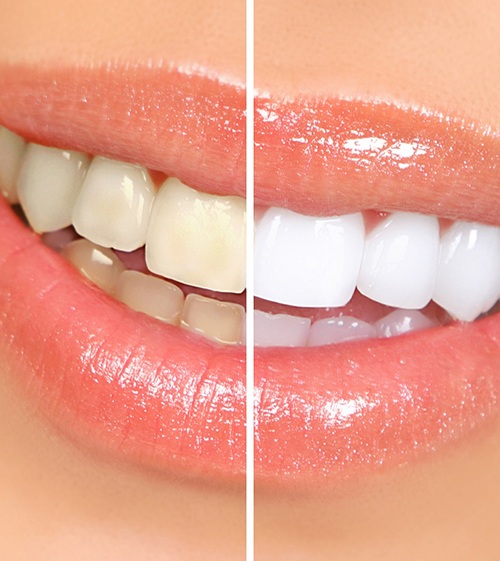 before-and-after comparison of teeth whitening in North Grafton