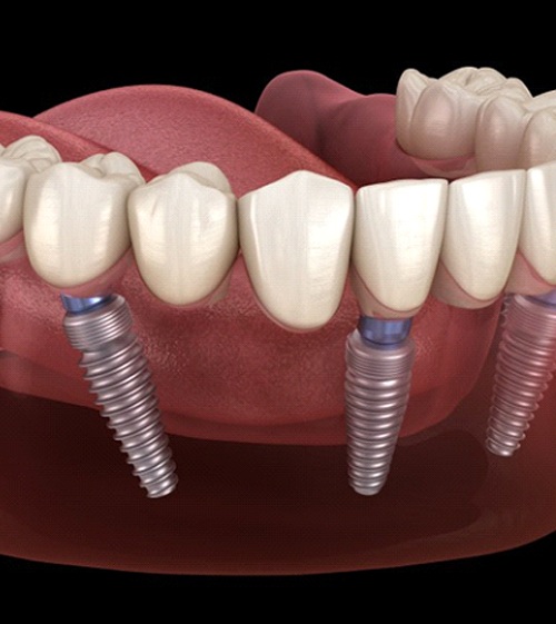 Digital illustration of All-On-4 dental implants in North Grafton