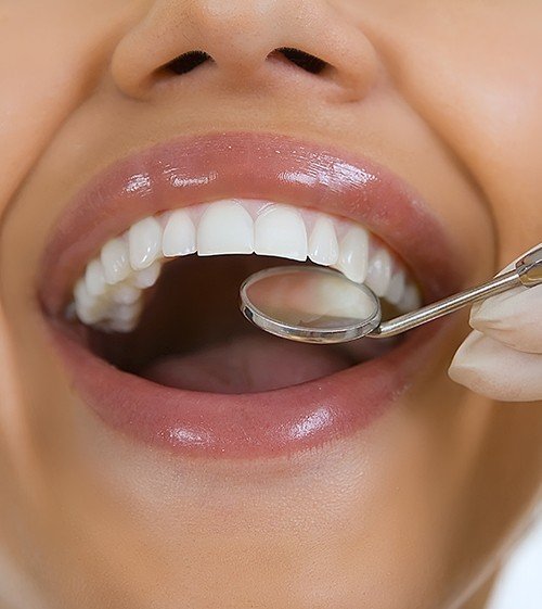 Closeup of patient tooth-colored filling restorative dentistry treatment