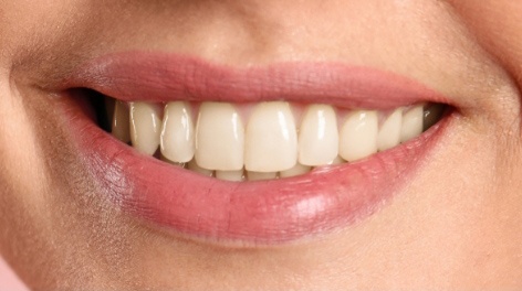 Smile before teeth whitening