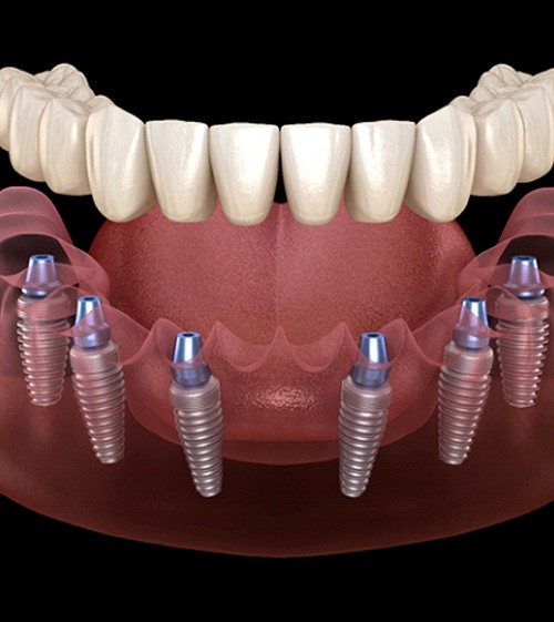 A digital image of 6 dental implants sitting on the lower arch while an implant-retained denture prepares to be placed on top
