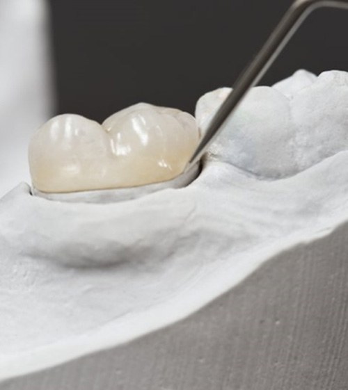 a dental crown being developed in North Grafton