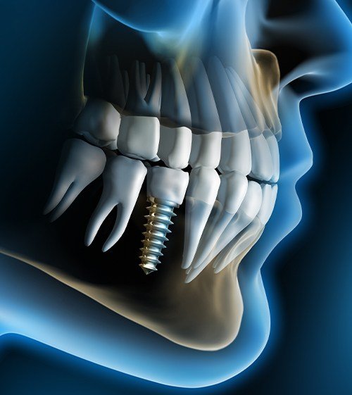 Animated facial profile with dental implant supported dental crown visible in smile