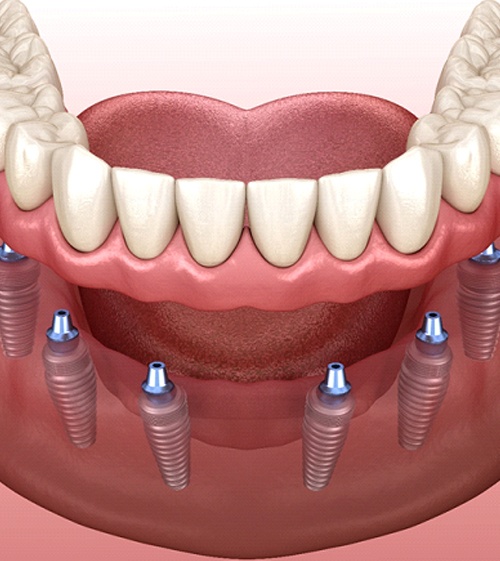 six dental implants supporting a full denture on the lower arch