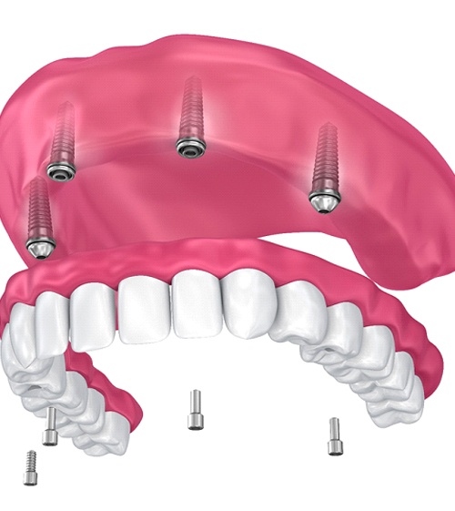 full implant denture on the upper arch
