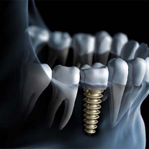 Tooth replaced by a dental implant in North Grafton