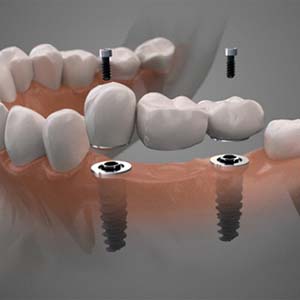 Dental implant bridge in North Grafton