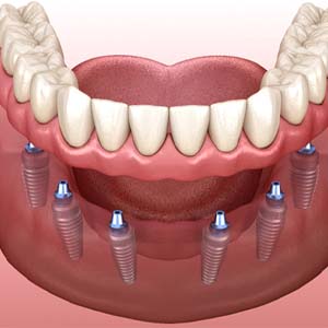 Dental implant dentures in North Grafton