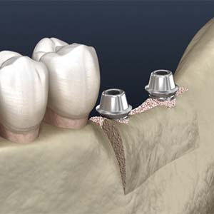 Illustration of two dental implants placed at site of ridge augmentation