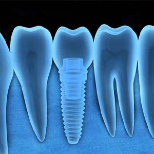 digital illustration of dental implant with antibacterial coating in North Grafton