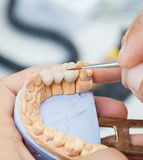 Dental bridge to replace missing teeth crafted in dental lab