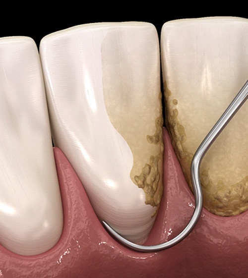 A digital image of a dental instrument removing plaque and bacteria from beneath the gum line