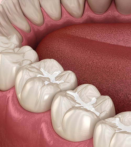 Animated row of teeth with tooth colored fillings in place
