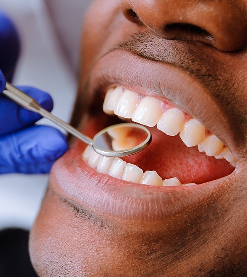 Dentist checking patient's teeth after tooth colored filling treatment