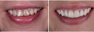 A person’s smile before and after receiving veneers in North Grafton